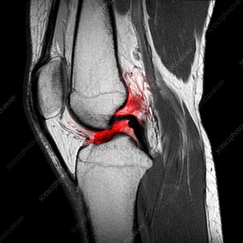 mri of acl tear images